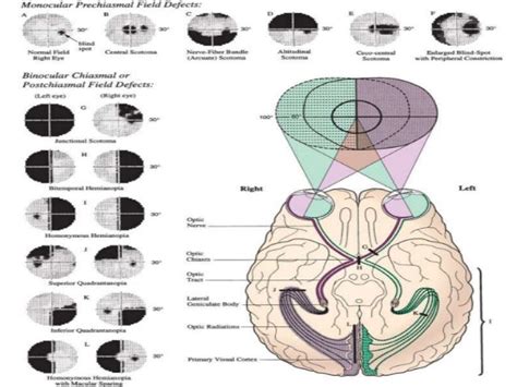 Occipital lobe 2 syndromes nwnw ppt