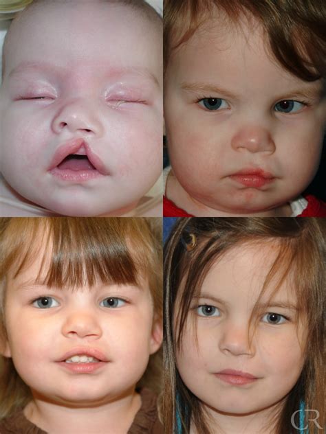 Cleft Lip & Palate - Kentucky Center for Cosmetic & Reconstructive Surgery