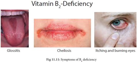 Vitamin B2 (Riboflavin) : Functions, Food Sources, Symptoms of deficiency