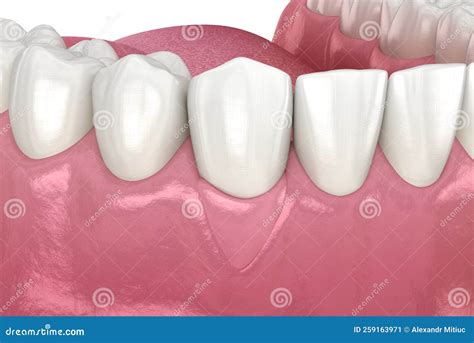 Gum Recession: Soft Tissue Graft Surgery. 3D Illustration of Dental Treatment Stock Illustration ...