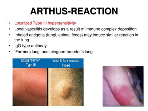 PPT - HYPERSENSITIVITY REACTIONS PowerPoint Presentation, free download - ID:5681371