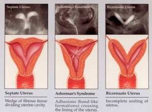 Image Gallery septate uterus