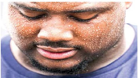 Experts link excessive sweating to diabetes, nervous disorders