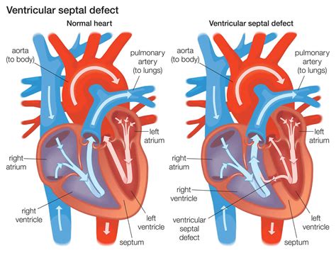 Ventricular septal defect causes, types, symptoms, diagnosis, treatment & prognosis