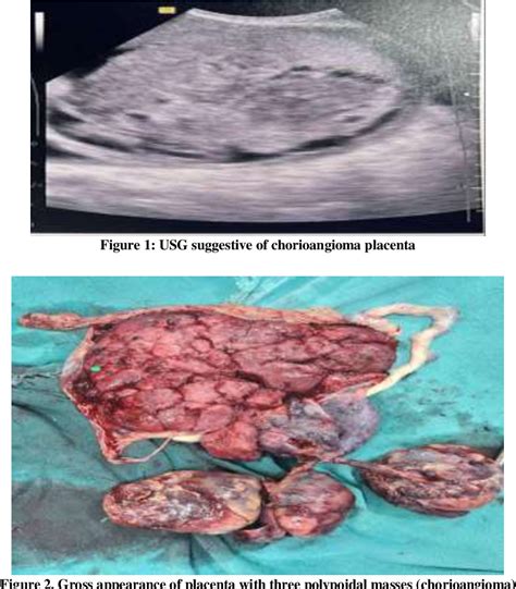 Figure 1 from Amniotic Fluid Abnormality with Giant Chorioangioma of ...