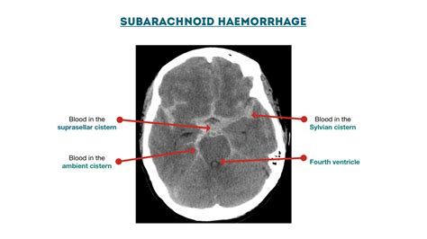 CT Head Interpretation | Radiology | Geeky Medics