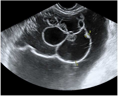 Teratoma Ovary Ultrasound