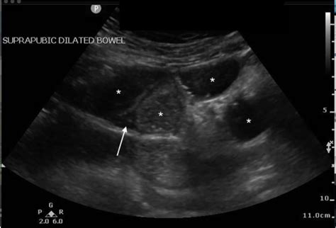 Abdominal Pain in the Elderly Patient: Point-of-care Ultrasound Diagnosis of Small Bowel ...