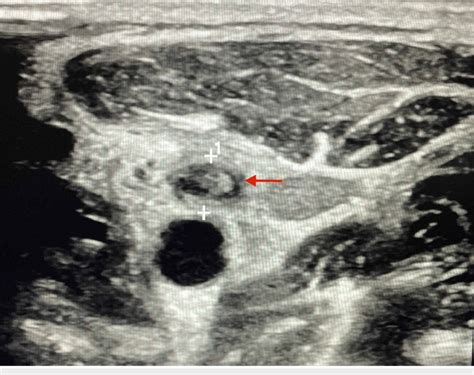 External Jugular Vein Thrombosis