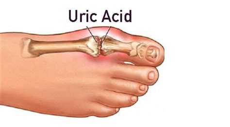 The Importance Of The Uric Acid Tests | Get Rid Of Gout