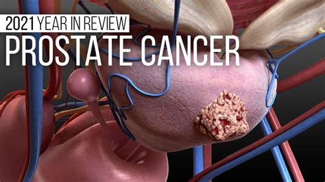 Year in Review: Prostate Cancer | MedPage Today