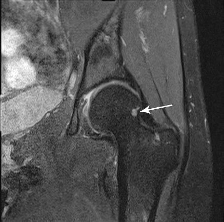 Coronal intermediate-weighted image (2180/13) with fat saturation. Note ...