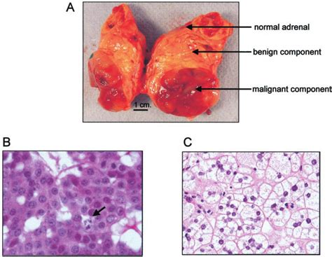 A, Macroscopic features of the adrenocortical tumor. Arrows show the... | Download Scientific ...