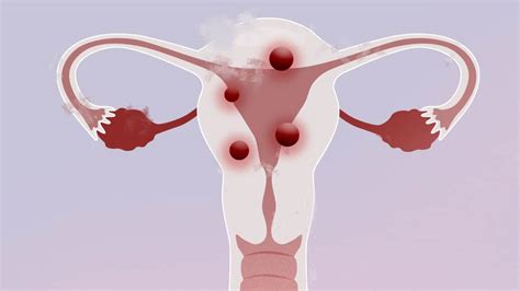 Diagnóstico y Tratamiento de los Miomas Uterinos Ginecología IB