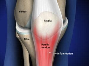 Patellar Tendonitis Treatment in IL | Kneecap Pain Solutions | Dr. Chams