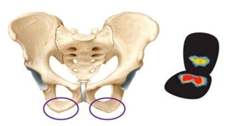 Ischial Tuberosity Syndrome Pain, Pictures, Treatment