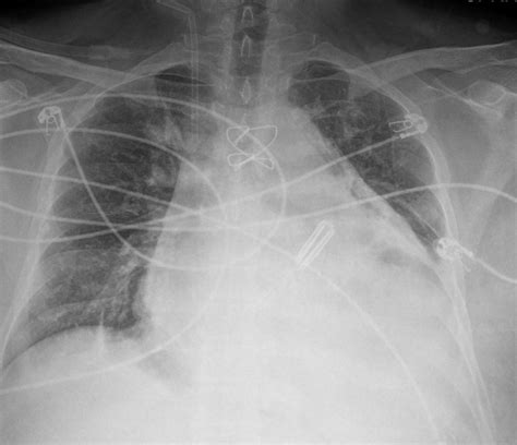 Devices in Radiology | Heart