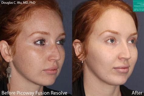 PicoWay Tattoo Removal San Diego, CA | Cosmetic Laser Dermatology