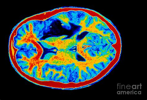 Colored Mri Scan Of Brain Cancer Photograph by Scott Camazine - Pixels