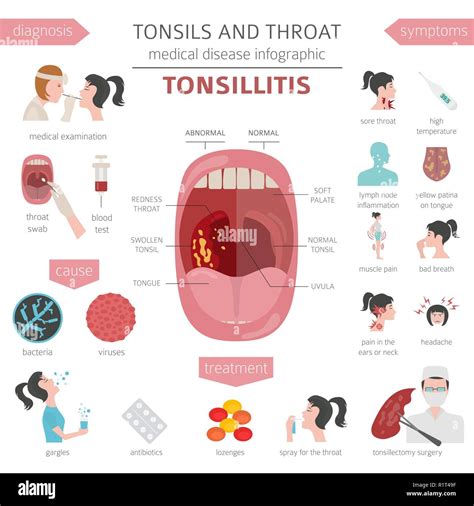 Tonsillitis Treatment