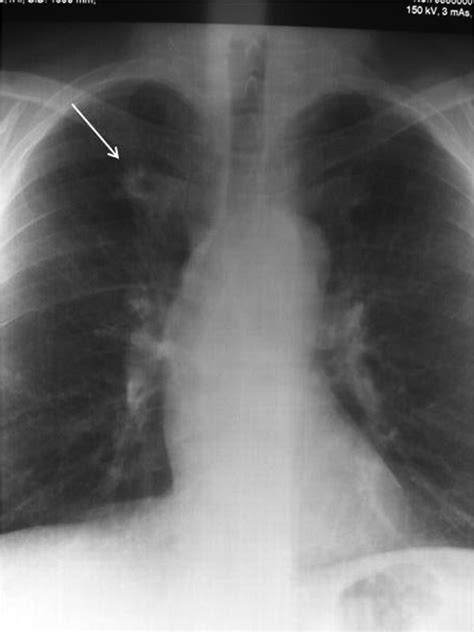 Pulmonary Nodulosis and Aseptic Granulomatous Lung Disease Occurring in ...