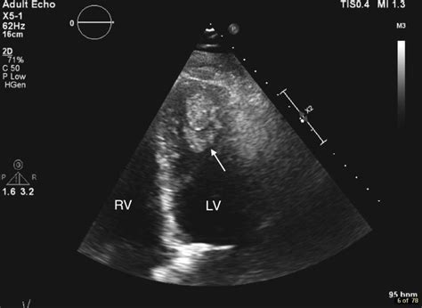 Left ventricular mural thrombus despite treatment with dabigatran and clopidogrel | BMJ Case Reports