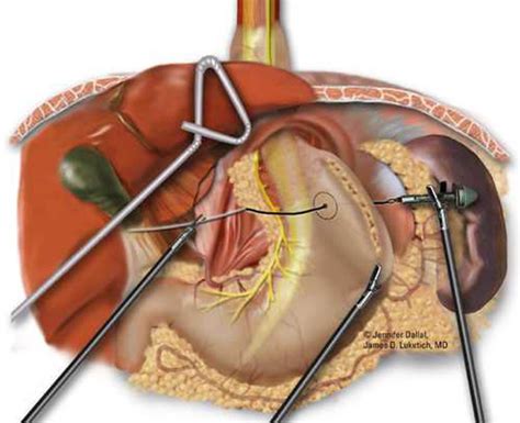 Laparoscopic Repair of Giant Paraesophageal Hernias | CTSNet