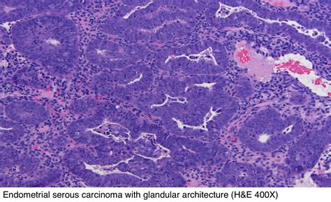 Pathology Outlines Serous Carcinoma | Free Nude Porn Photos