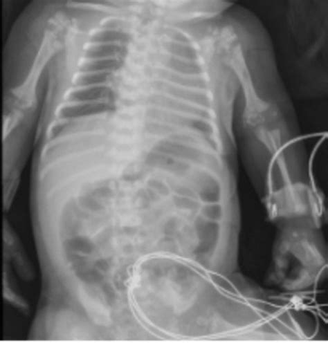 A case of Rhizomelic chondrodysplasia punctata in a neonate — MED-LIFE DISCOVERIES