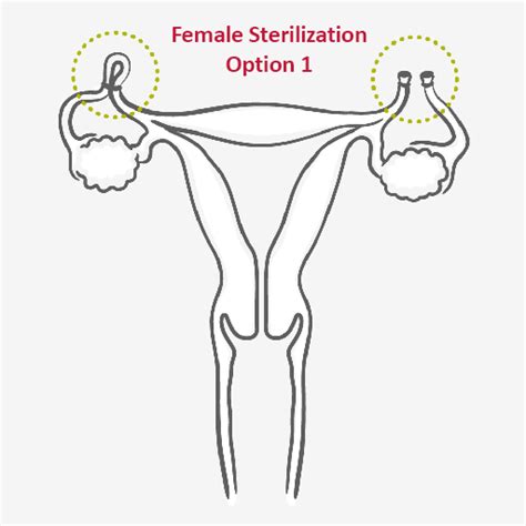 Sterilization - Permanent Method