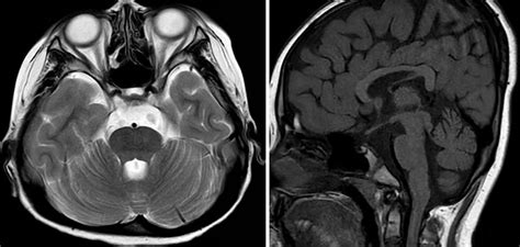 MRI images. (A) Enlarged anterior pontine cistern; (B) hypoplasia of... | Download Scientific ...