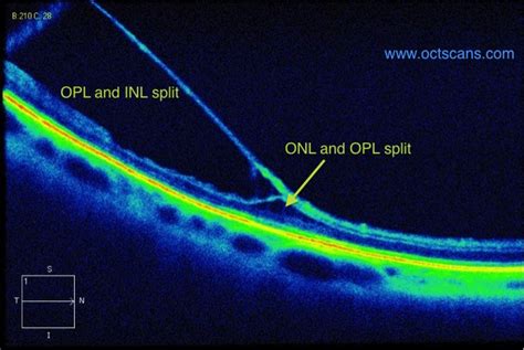 Retinoschisis - Optical Coherence Tomography Scans