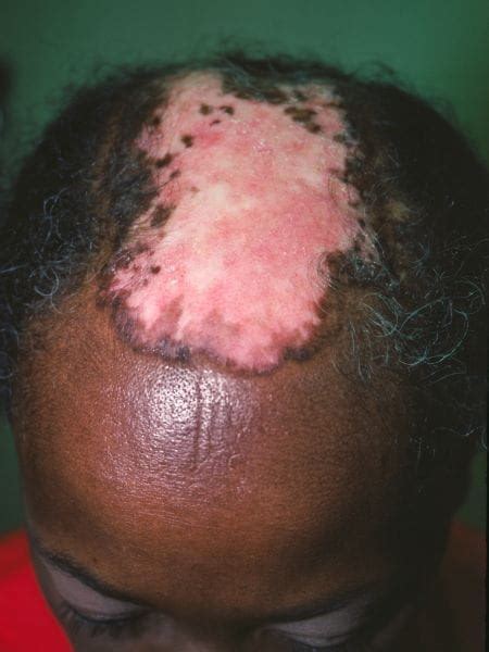 Image: Discoid Lupus Erythematosus (Scalp) - MSD Manual Professional Edition