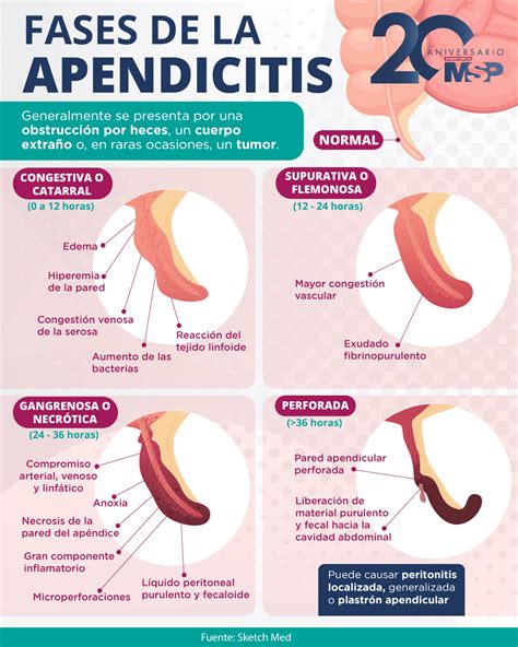 Fases de la apendicitis