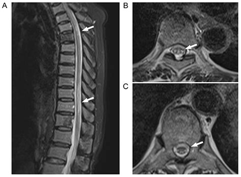 Subacute combined degeneration of the spinal cord with concomitant ...