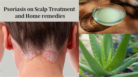 Psoriasis on Scalp Treatment and Home remedies