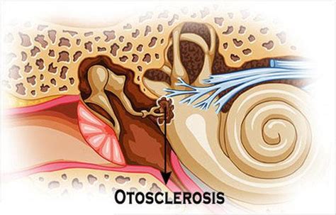 MBBS DOCTORS: OTOSCLEROSIS