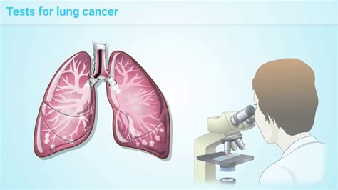 What is Lung Cancer? - YouTube