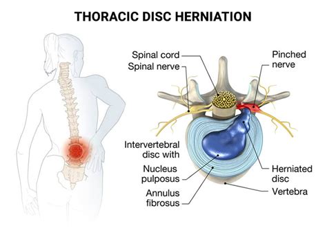 Thoracic Disc Herniation NJ & NYC