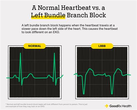 Left Bundle Branch Blocks on EKGs: Testing and Treatment - GoodRx