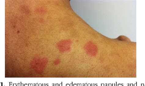 Figure 1 from Resolution of autoimmune progesterone dermatitis after ...