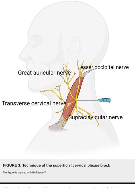 Figure 3 from Superficial Cervical Plexus Block in Selective Cases of ...