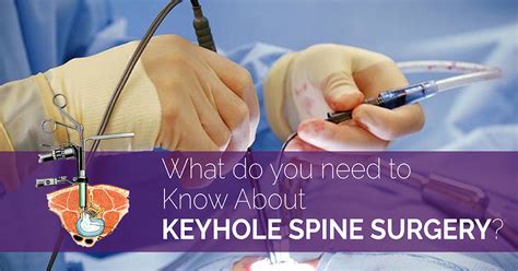 What Do You Need to Know About Keyhole Spine Surgery?