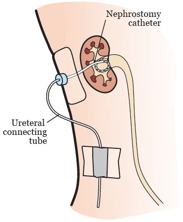 About Your Nephrostomy Catheter | Memorial Sloan Kettering Cancer Center