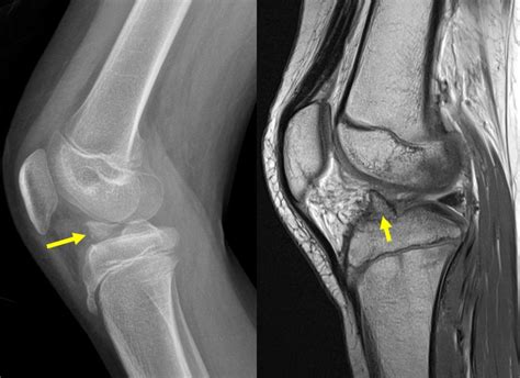 Avulsion fracture of ACL – Radiology Cases