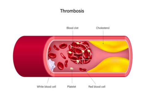 Cardiovascular Physiology - Chapter 8: Homeostasis: Coagulation ...