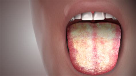 Candidiasis FI - Scientific Animations