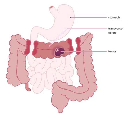 Bowel Obstruction Symptoms After Gastric Bypass