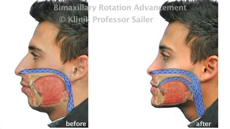 Patientreport after Sleep Apnea surgery - YouTube