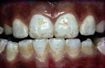 Dentistry and Medicine: Dental Fluorosis